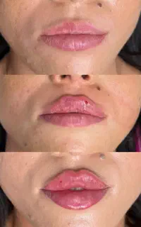 تزریق ژل ، بوتاکس و مرکز تخصصی لیزر با پزشک مجرب