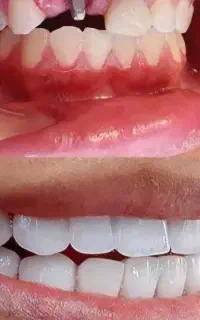 مژده .ایمپلنت. کره ای. دندان باقیمت باورنکردنی