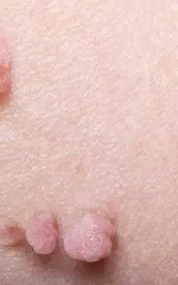 دفع تضمینی زگیل و تبخال