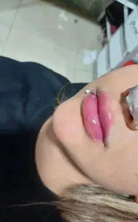 آف ژل بوتاکس مزو
