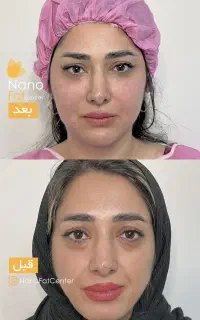 تزریق چربی صورت و بدن تکنیک نانوفت SVF