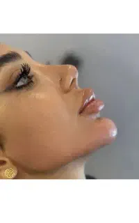 آموزش ژل و بوتاکس فقط با ۵ میلیون