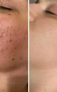 جوش و آکنه پوستی