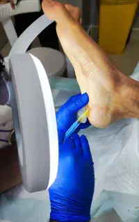 درمان تخصصی انواع زخم در ایلام با دستگاه مدرن