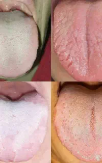 چکاب داخلی بدن از روی عکس زبان