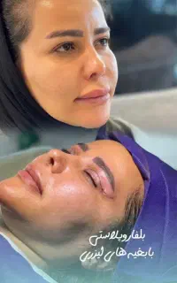 افتادگی پلک،تضمینی لیزری vipتیم جراح زیبایی پلک