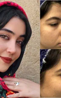 جراحی بینی تخصصی ، باقیمت ویژه،۵۰درصد آف