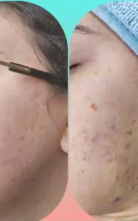 مزوتراپی صورت و بدن