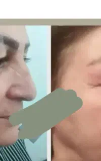 پوست صاف و شفاف دیگر ارزو نیست