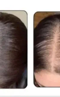 بیا کمکت کنم از شر ریزش و کم پشتی خلاص شی