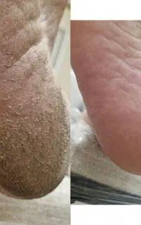 پدیکور تخصصی، درمان پاهاتون بای جلسه