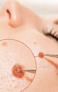 لیزر زگیل hpvخال،میخچه.لیزر تتو ،هموروئید پیرسینگ