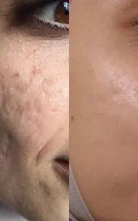 شفاف سازی صورت