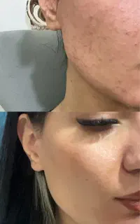 پکیج vip رفع جای جوش،لک و منافذ باز