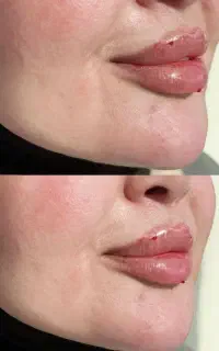 اموزش ژل  بوتاکس امپول لاغری