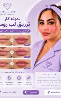 تزریق ژل و بوتاکس خانم ها و آقایان