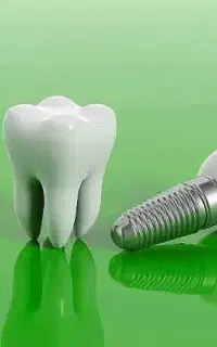 ( ایمپلنت دیجیتال فقط با 10 تومن )