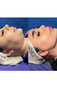 خفن ترین غبغب با ابداع کننده سوپر کانتورینگ