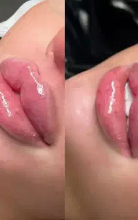 ژل و بوتاکس