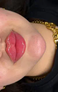 بوتاکس/ژل/فیلر لب/هایفو/مزو پی آر پی