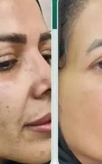 مزوتراپی پوست