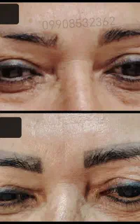 پاک کردن با دستگاه لیزر کیوسوئیچ درچه