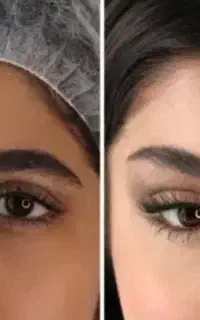 بوتاکس ۷۵۰فیلر بیکینی فقط ۷۵۰۰ لیفت شقیقه ابرو ۲۰م