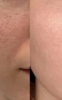 اگر صورتت جوش میزنه،ببین