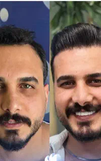 کاشت تخصصی و فول تراکم مو وریش در شیراز