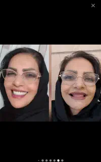 دندان منصوعی ازهمه ارزونتر باکیفت بالا