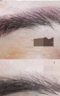 فیبروز ، آنزیم تراپی ،میکرو نیدیلینگ جوانسازی پوست