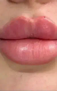 جشنواره فیلر/ژل(فقط850تا فردا)درمطب/پزشک تضمینی