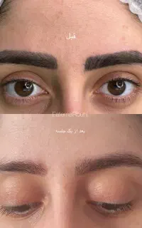 «جذب مدل محدود ریموو تتو با شرایط ویژه »