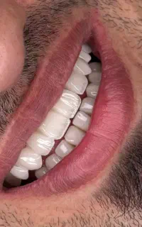 مرکز  دندانپزشکی ک یغموری* روکش - ایمپلنت - زیبایی