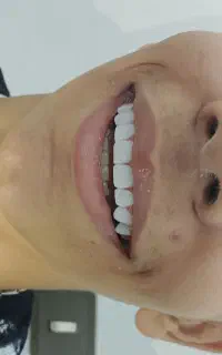 کامپوزیت ونیر طرح لبخند