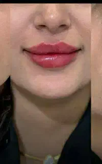 مزو،بوتاکس ،چربی،فیلر