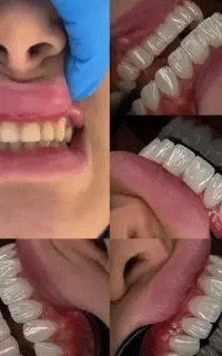 کامپوزیت لب شفاف سرو