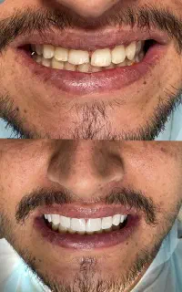 جشنواره دندانپزشکی کامپوزیت
