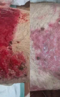 کارشناس زخم و استومی (پرستار رسمی مراقبت ویژه)