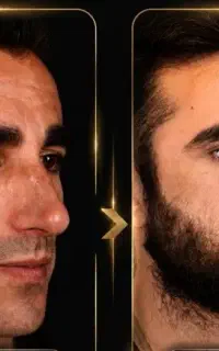 ارومیه/نمونه عمل بینی دکترغنی زاده/معرفی کانال