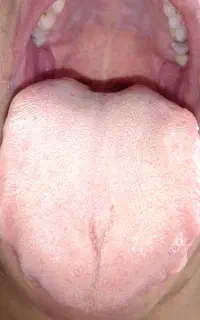 تشخیص بیماریها با توجه به عکس زبان