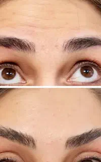 کارگاه حضوری آموزش بوتاکس توسط پزشک