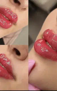 تزریق ژل وبوتاکس وانزیم،لیفت نخ،فیلربادی پلاسما