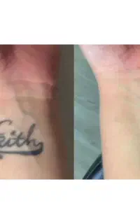 جشنواره حذف تتو و خالکوبی تضمینی درمطب پزشک