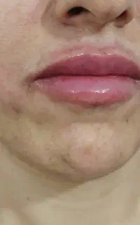 تخفیف فیلر و بوتاکس ویژه روز دختر