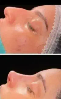 عمل بینی و جراحی لیفت صورت لیپو و ابدو