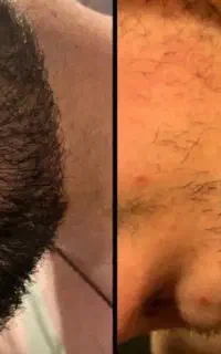 از کم پشتی به پرپشتی