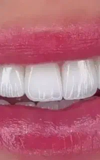 عصبکشی روکش کامپوزیت دندانپزشکی چیتگر آزادی صادقیه