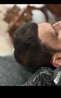 کاشت مو ،ابرو،ریش،