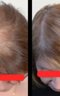 پی آر پی/مزوتراپی/ریزش مو/کاشت مو/ چربی کف سر